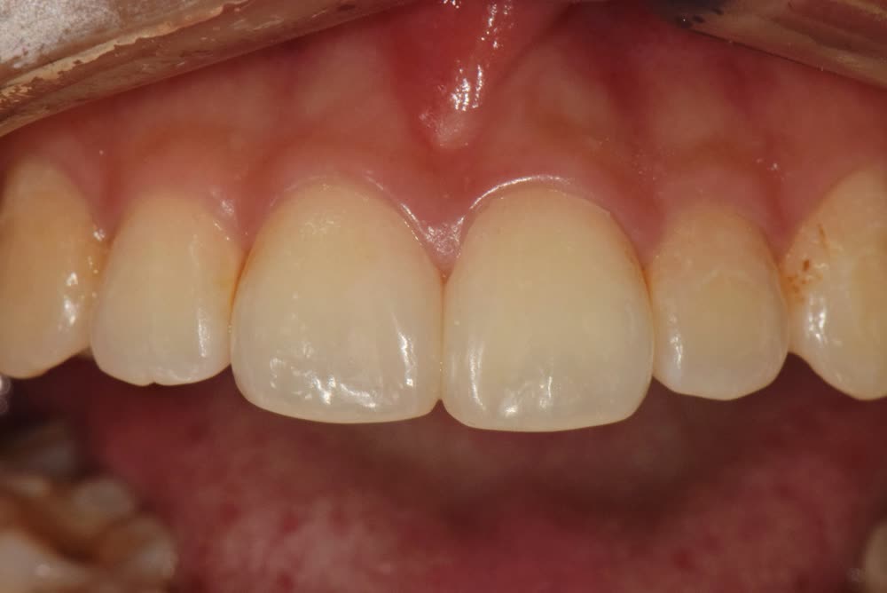 앞니 사이 틈 — 레진으로 메우기 치료 후
